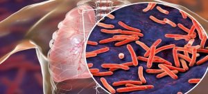 Casos de tuberculosis pulmonar en Los Mochis
