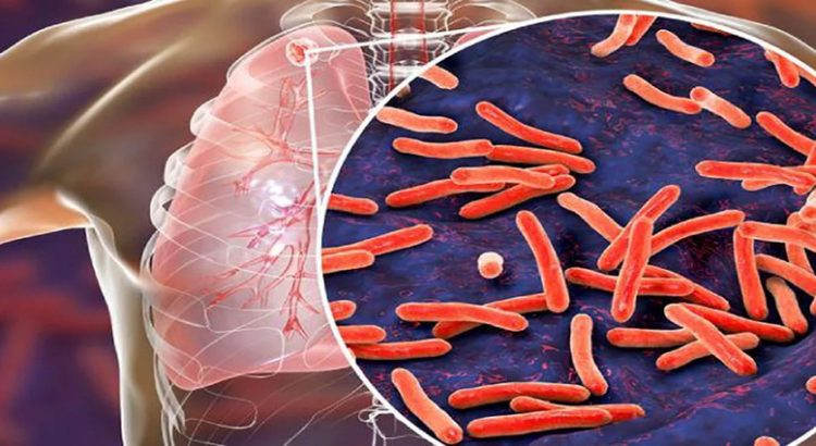 Casos de tuberculosis pulmonar en Los Mochis