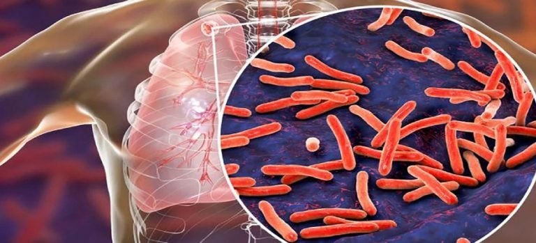 Casos de tuberculosis pulmonar en Los Mochis