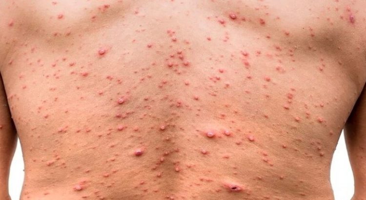 Sinaloa llega a los 14 casos positivos de viruela del mono