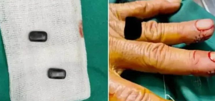 Se implantó imanes en los dedos Se implantó imanes en los dedos